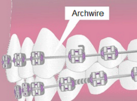 Archwire