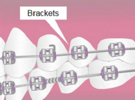 Brackets