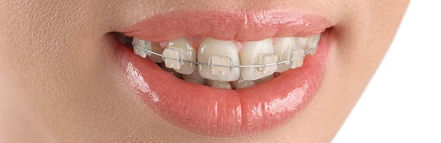 Ceramic Braces